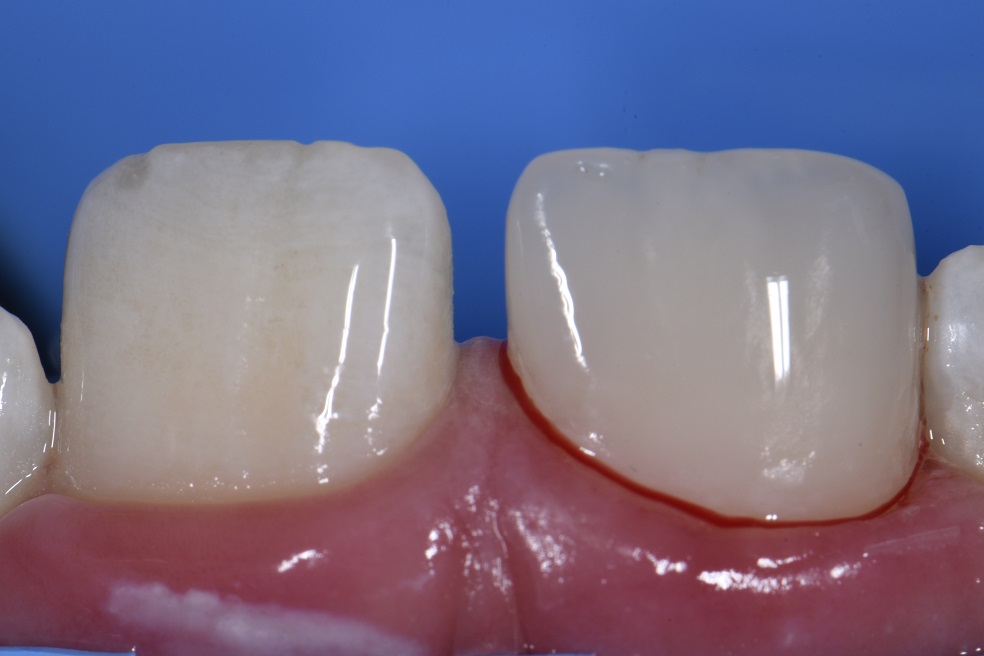 do 11 year olds lose teeth do 11 year olds lose teeth