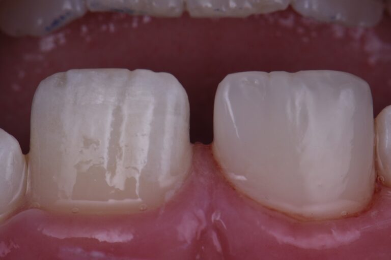 do 11 year olds lose teeth do 11 year olds lose teeth