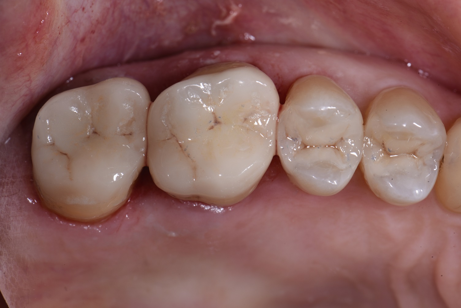 Quadrant Dentistry with Overlays and Composite
