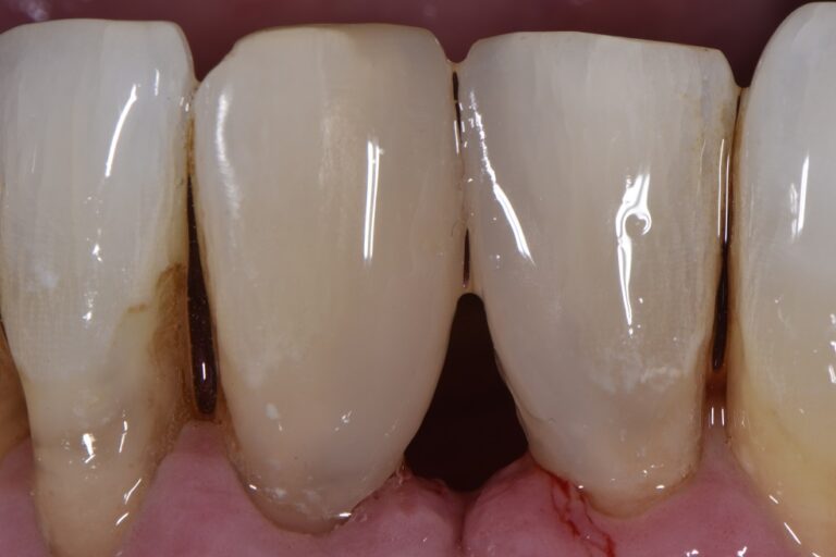 Closing Large Gaps between Teeth with Composite