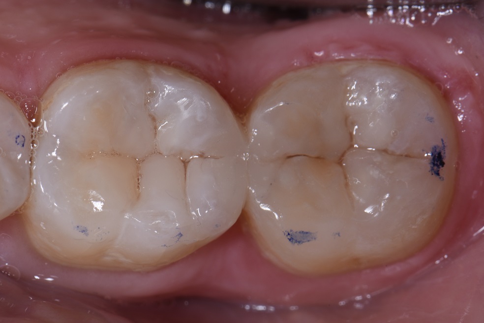 Conservative Preparations for Occlusal Caries