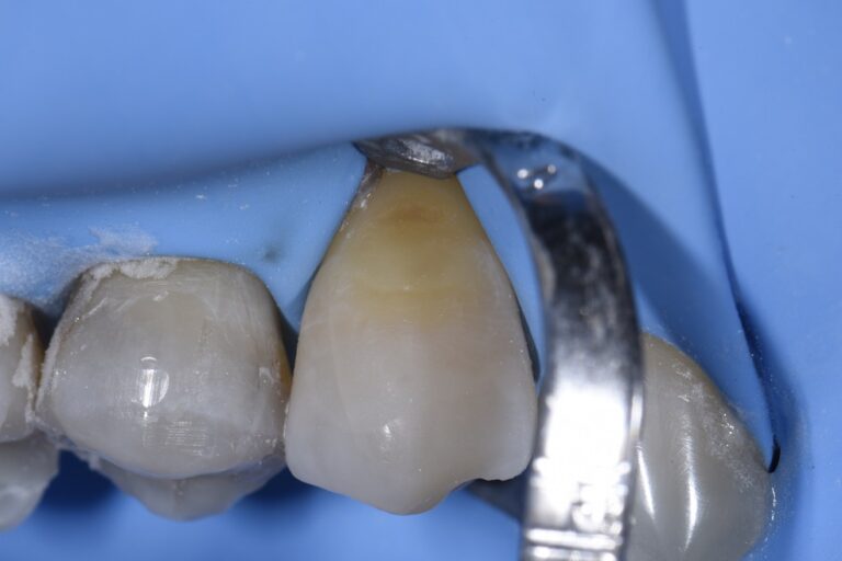 Absolute Isolation for Class V restorations