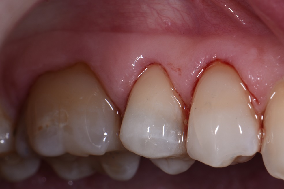 Absolute Isolation for Class V restorations