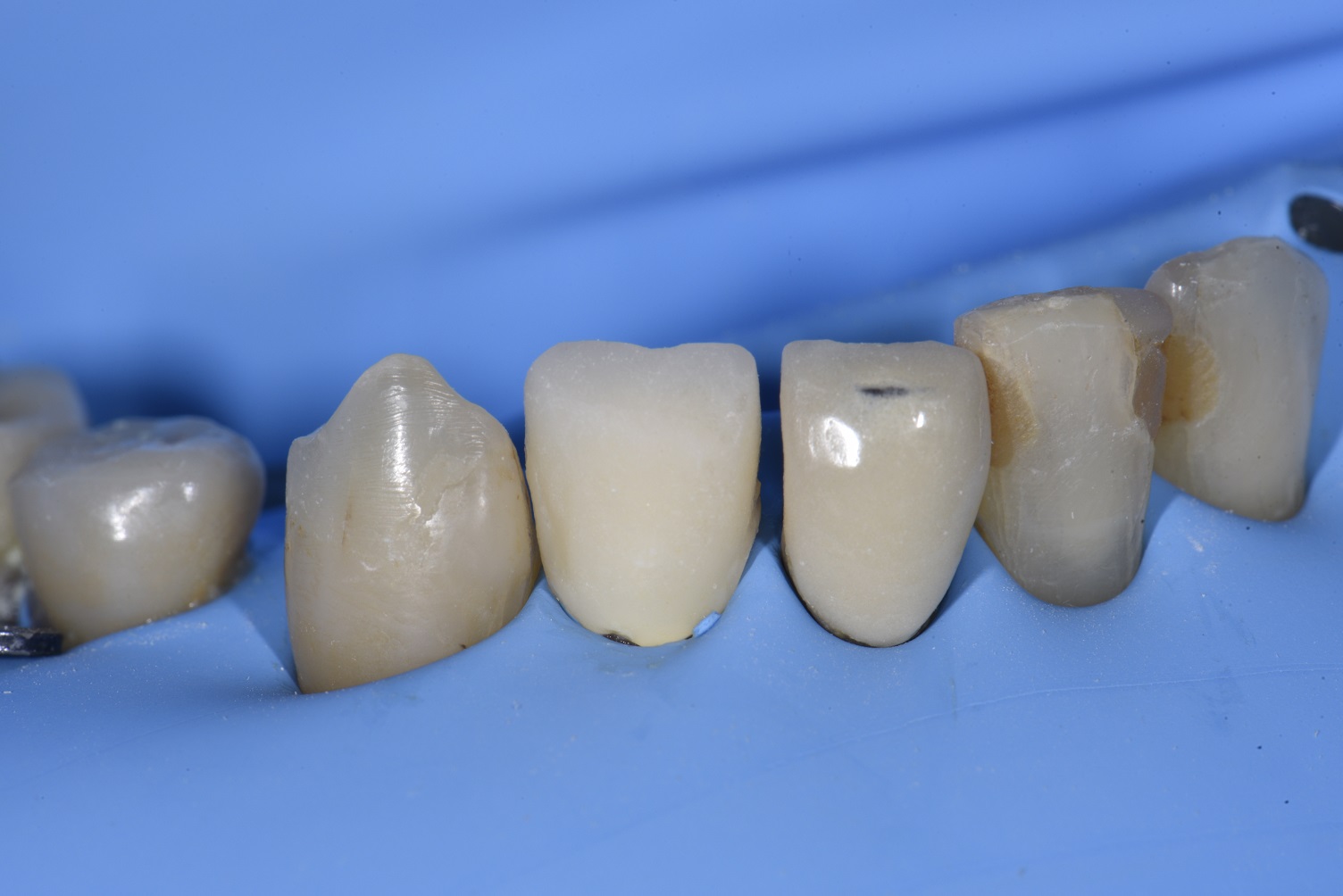Absolute Isolation with Rubber Dam Adhesive Cementation