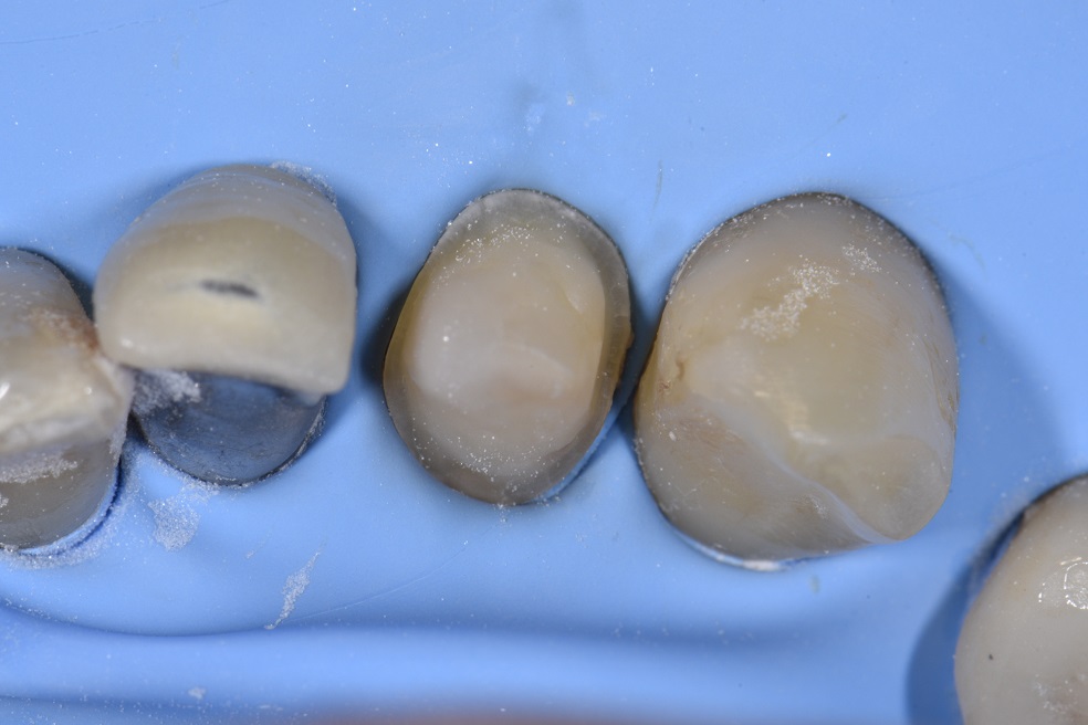 Absolute Isolation with Rubber Dam Adhesive Cementation