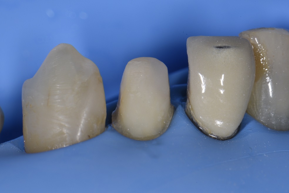 Absolute Isolation with Rubber Dam Adhesive Cementation