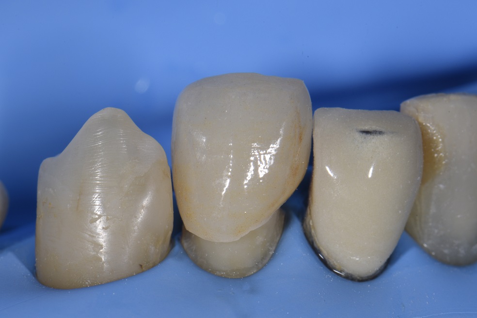 Absolute Isolation with Rubber Dam Adhesive Cementation