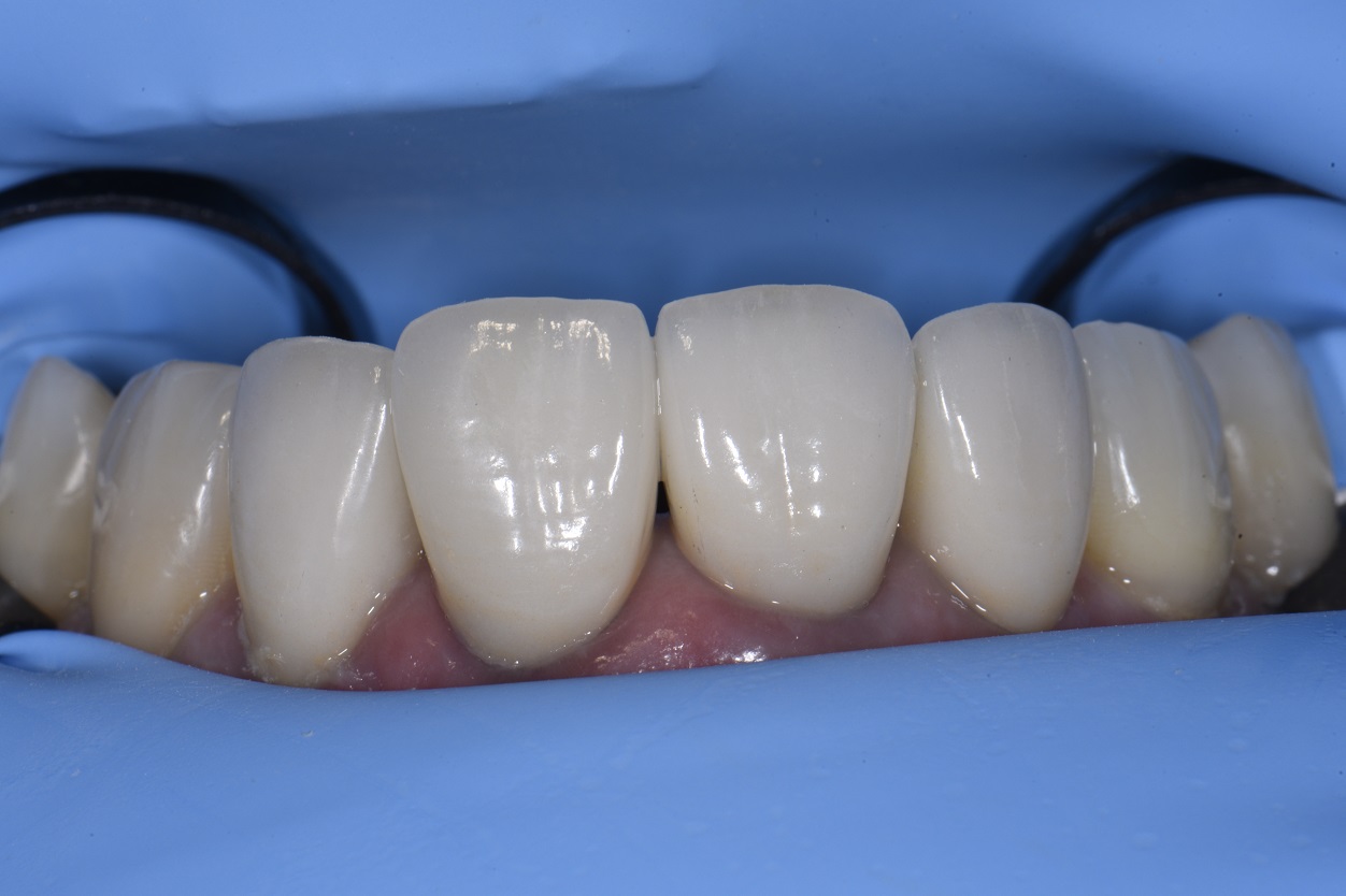 Removal of old crowns, immediate dentin sealing and resin coat