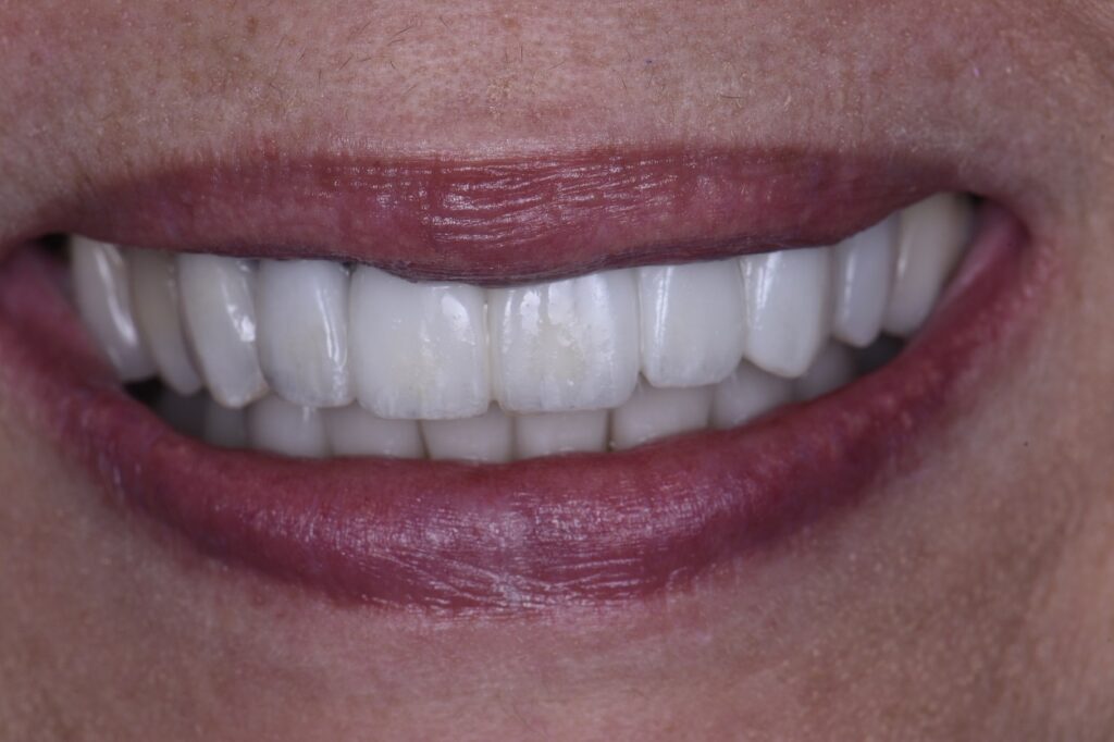 Provisional Restorations that look realistic af