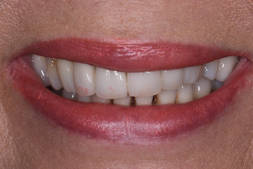 Provisional Restorations that look realistic af