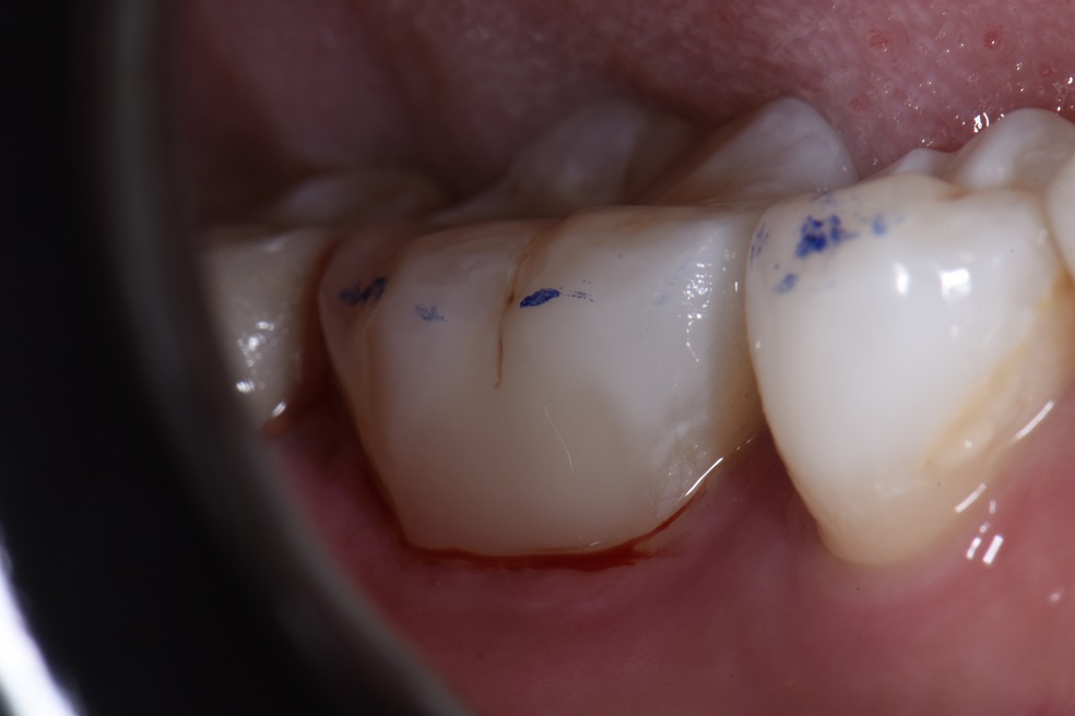 Difficult Isolation for this Complex Layered Composite Restoration