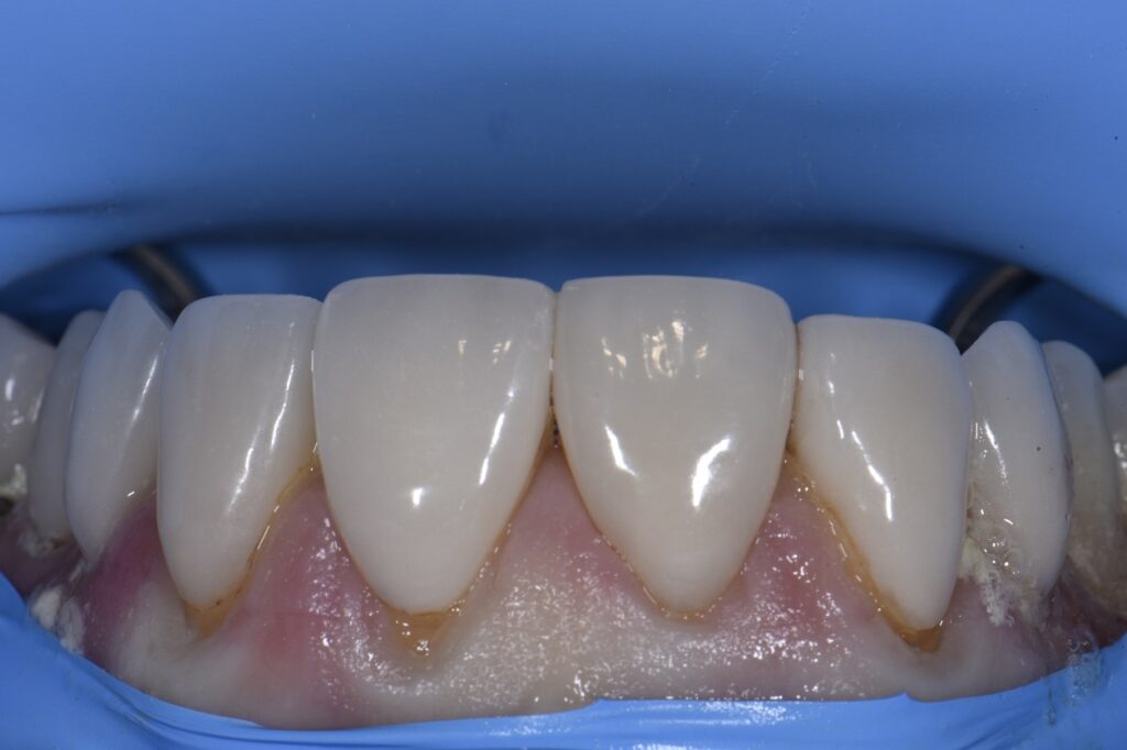 Veneer Preparations and Provisionalization Temporization