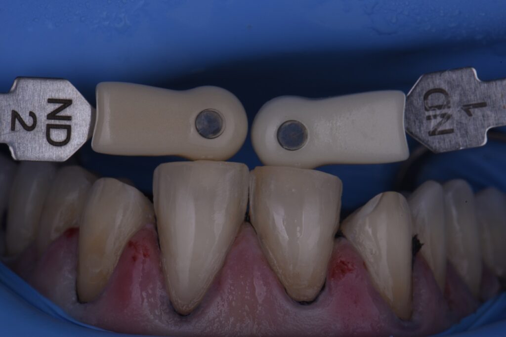 Veneer Preparations and Provisionalization Temporization