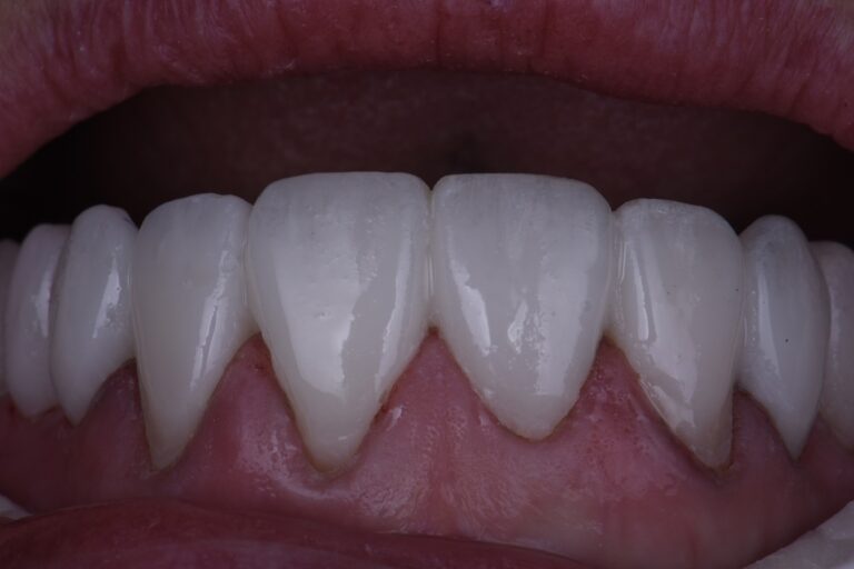 Veneer Preparations and Provisionalization Temporization