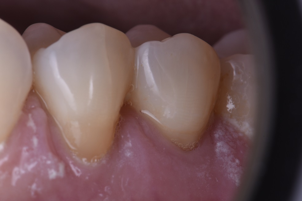 Class V restorations to seal dentin
