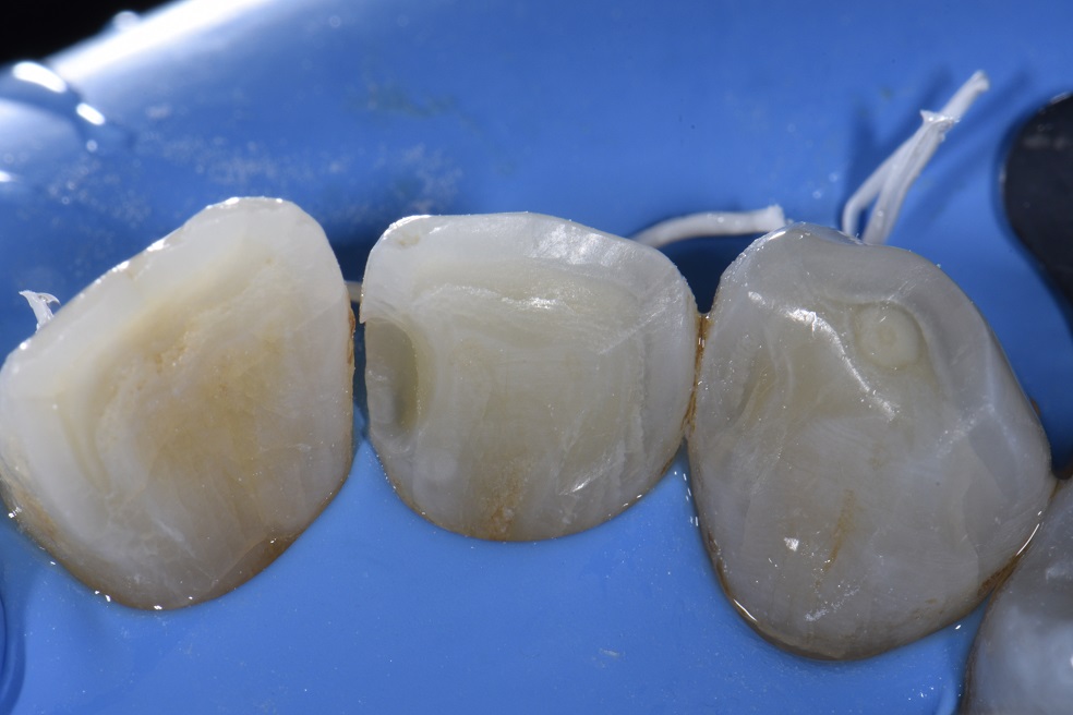 Class III restorations