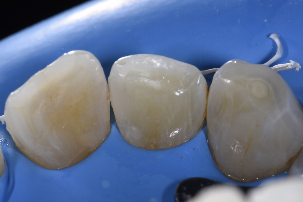 Class III restorations