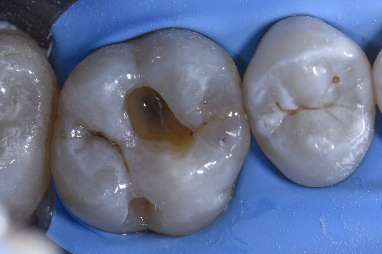 Amalgams made Invisible with Composite Resin