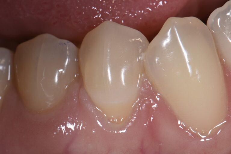 Sensitive Root desensitizing treatment