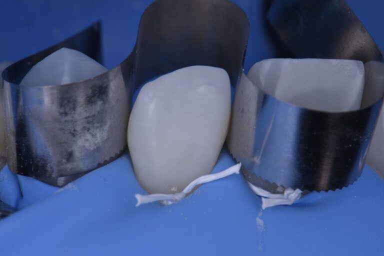 Reshaping lateral incisors noninvasively with composite resin
