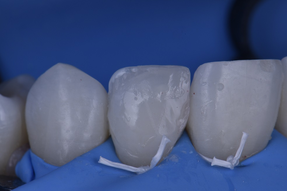 Reshaping lateral incisors noninvasively with composite resin