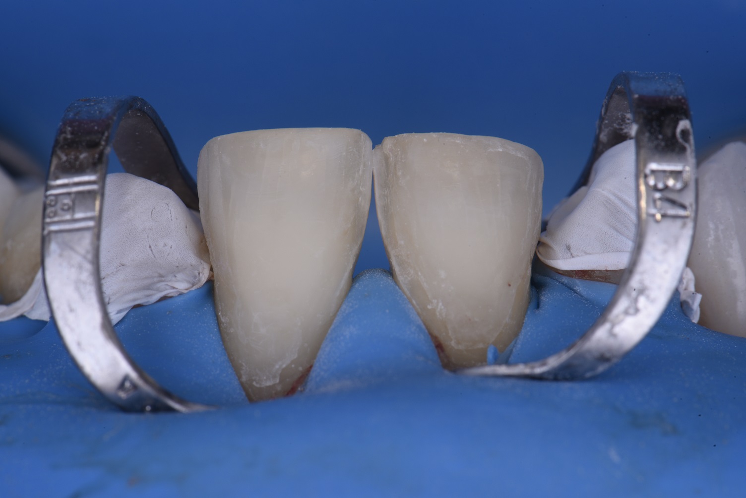 Cementation Workflow using Ultimate Isolation