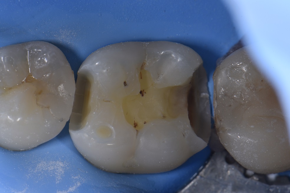 Class II composite restorations with a