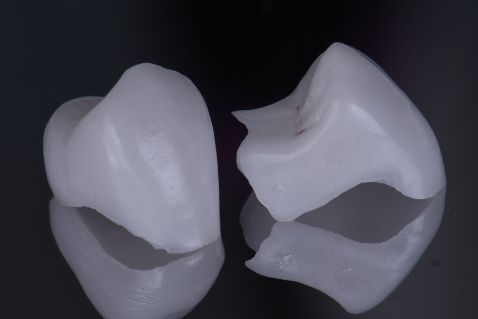 Translucent conservative porcelain onlay and overlays