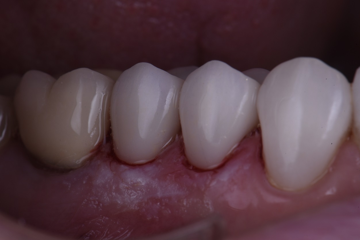 Translucent conservative porcelain onlay and overlays