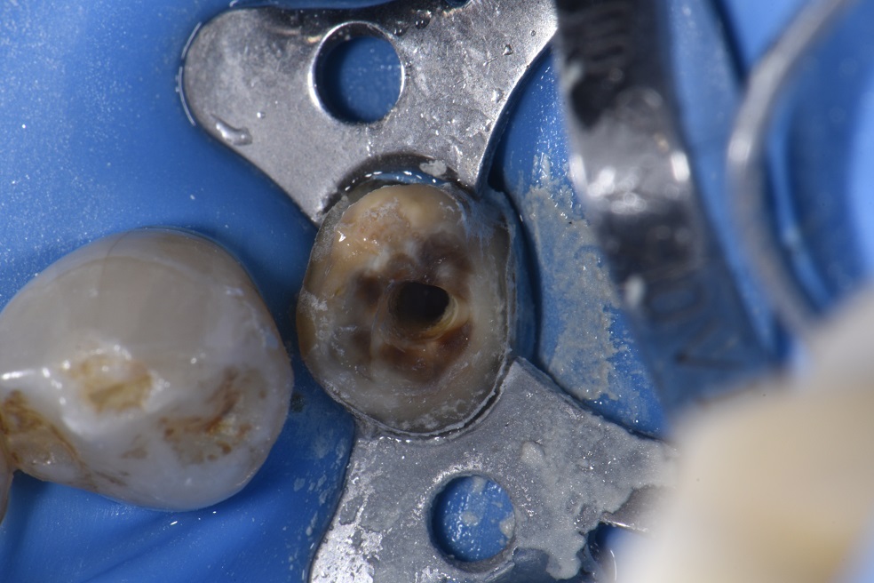 Creating Shockproof foundations on compromised teeth