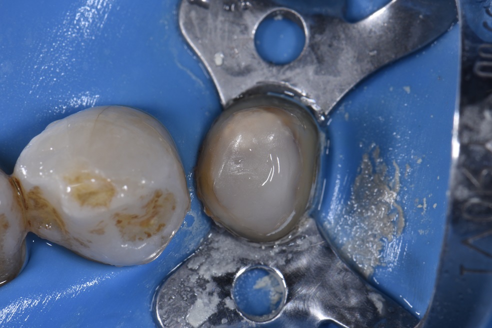 Creating Shockproof foundations on compromised teeth