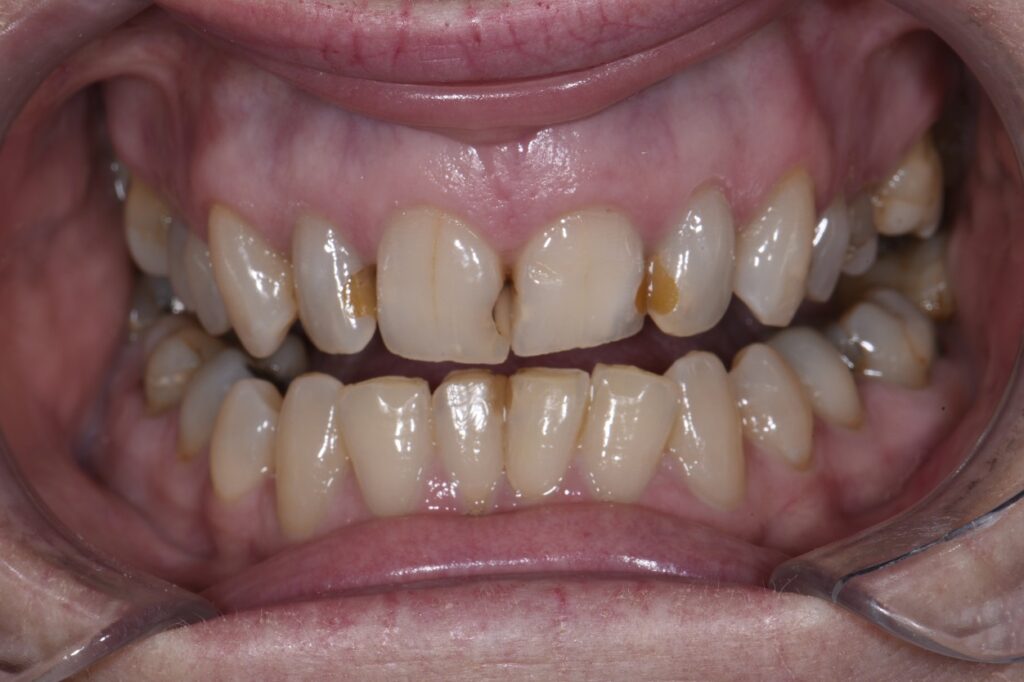 Replacement of Failed Restorations in the upper anterior sextant