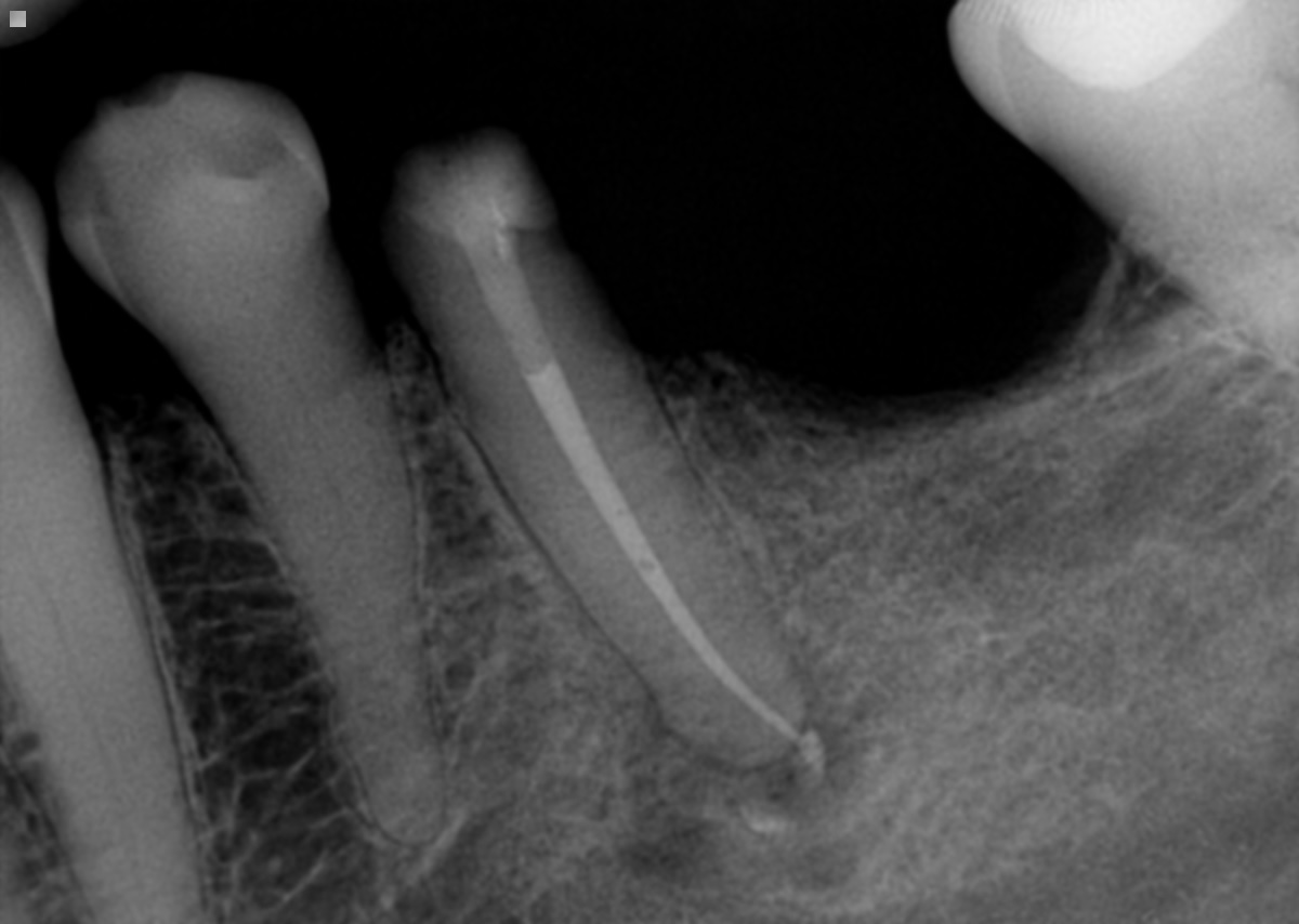 Creating Shockproof foundations on compromised teeth