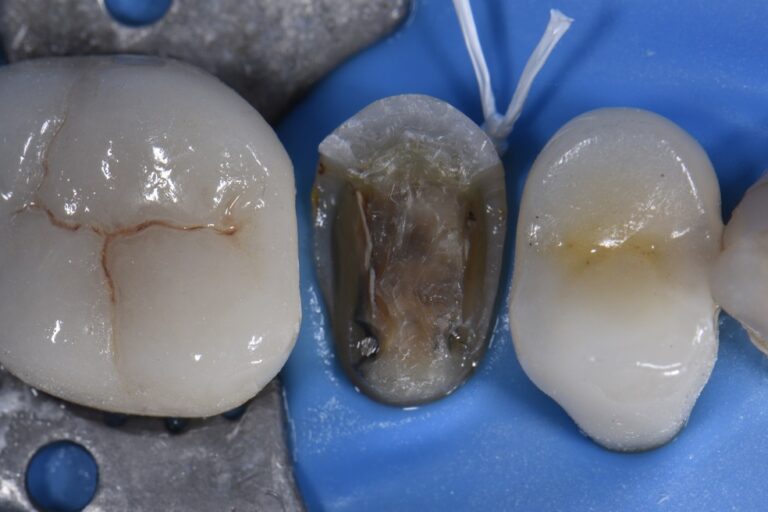 Adhesive Bonding Protocol for emax overlay Adhesive Bonding Protocol