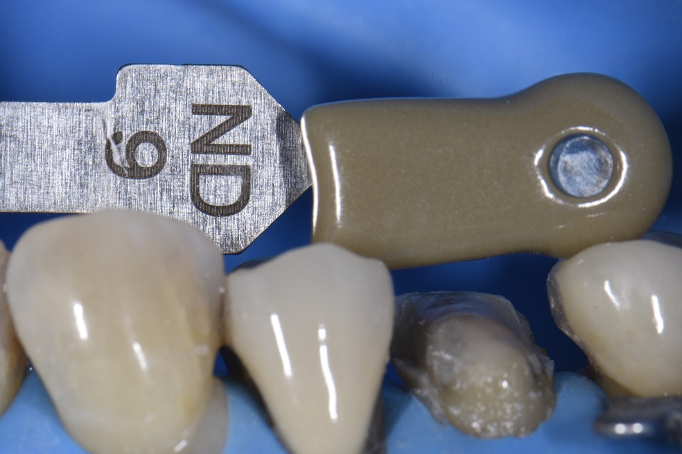 Adhesive Bonding Protocol for emax overlay Adhesive Bonding Protocol