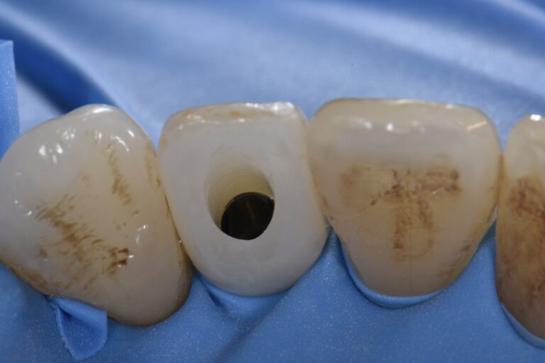 Zirconia Implant Crown Screw Access Closure