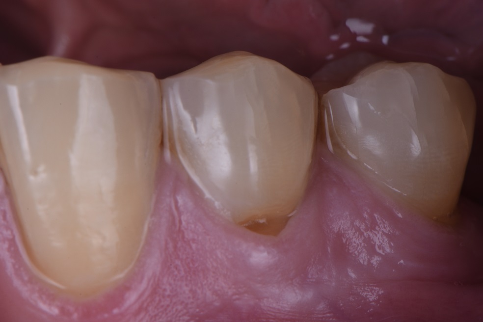 Root abrasion lesions from toothbrushing