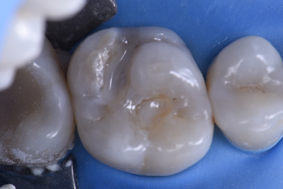 Hairline Fracture and Amalgam Removal Hairline Fracture and Amalgam Removal