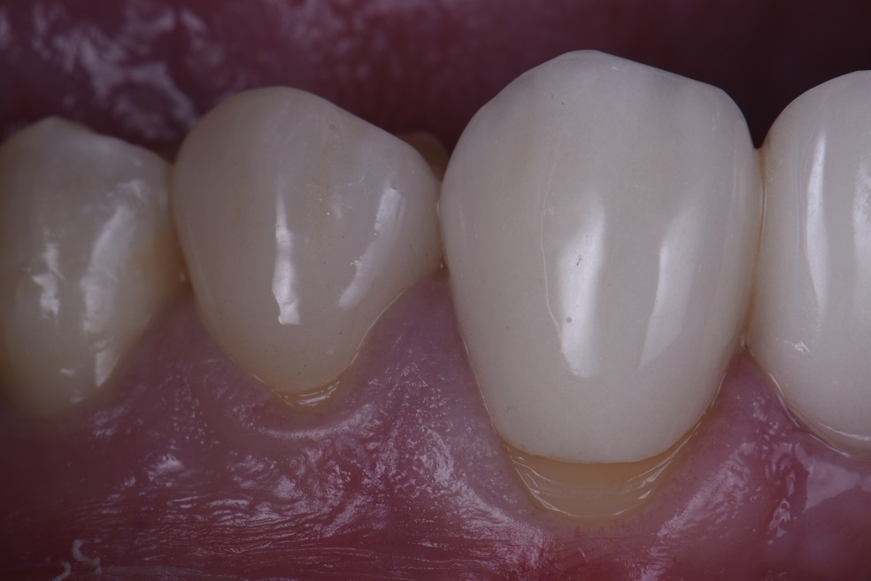 Bonding to Zirconia Bonding to Zirconia