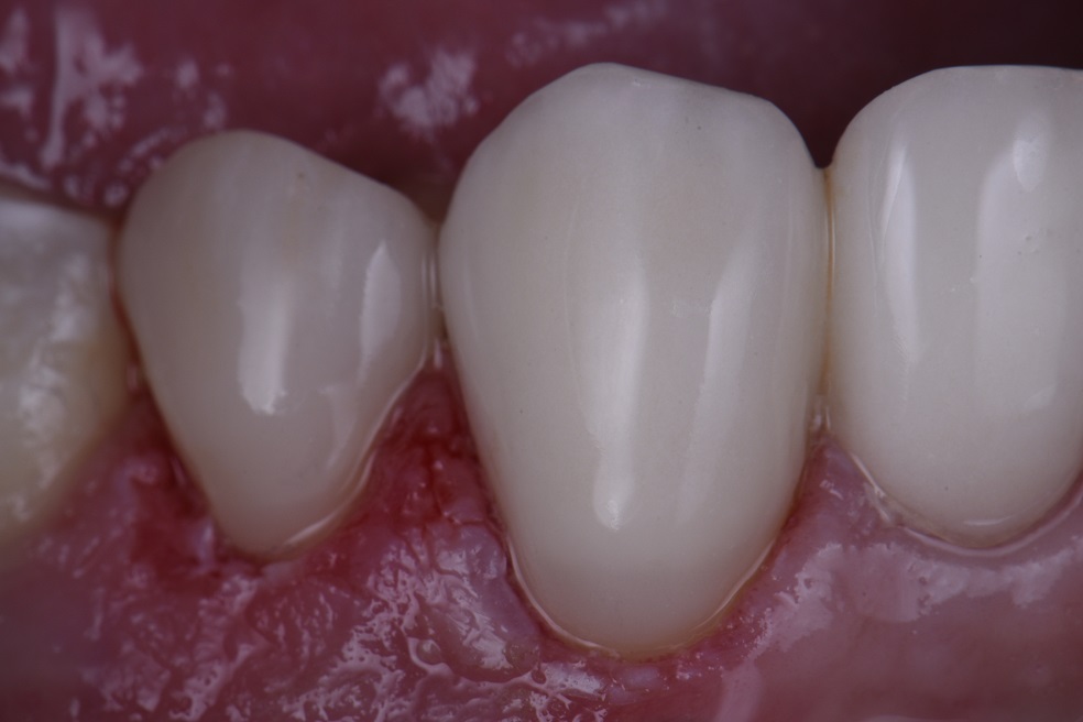 Bonding to Zirconia Bonding to Zirconia