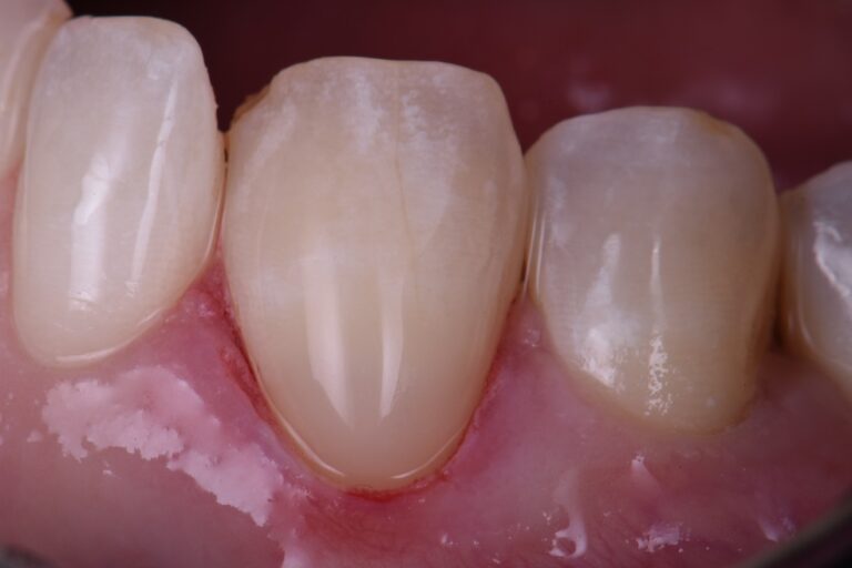 Class V restorations with Essentia U Class V restorations with Essentia U