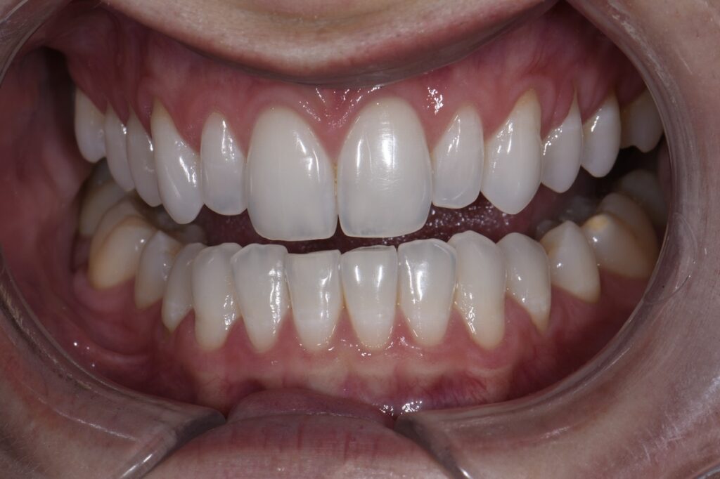 Composite Veneers without drilling