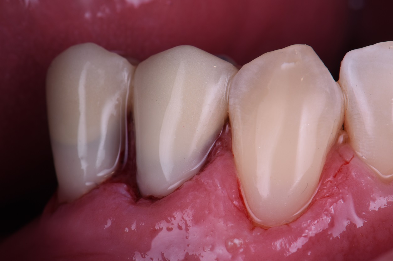 Bonding to Porcelain, Metal and Tooth Structure in Restorative