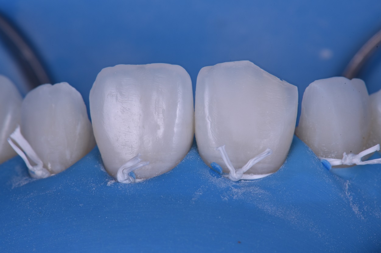 Composite Replacement Restorations Kerr Harmonize Composite Replacement