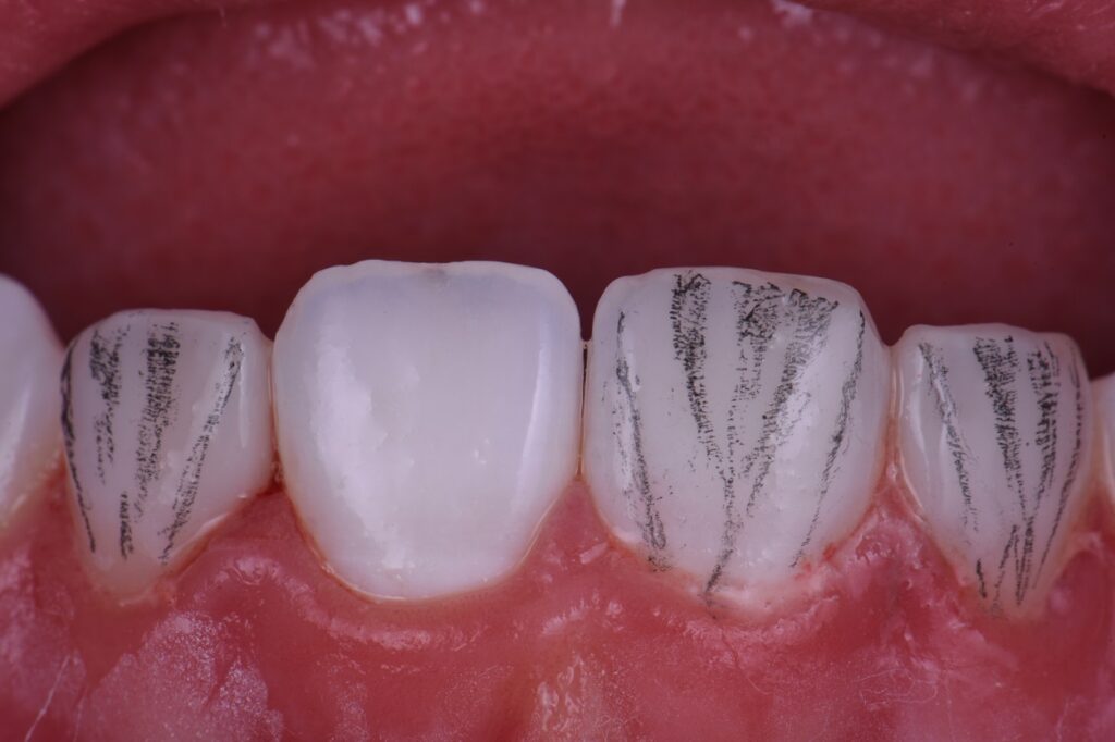 Composite Replacement Restorations Kerr Harmonize Composite Replacement