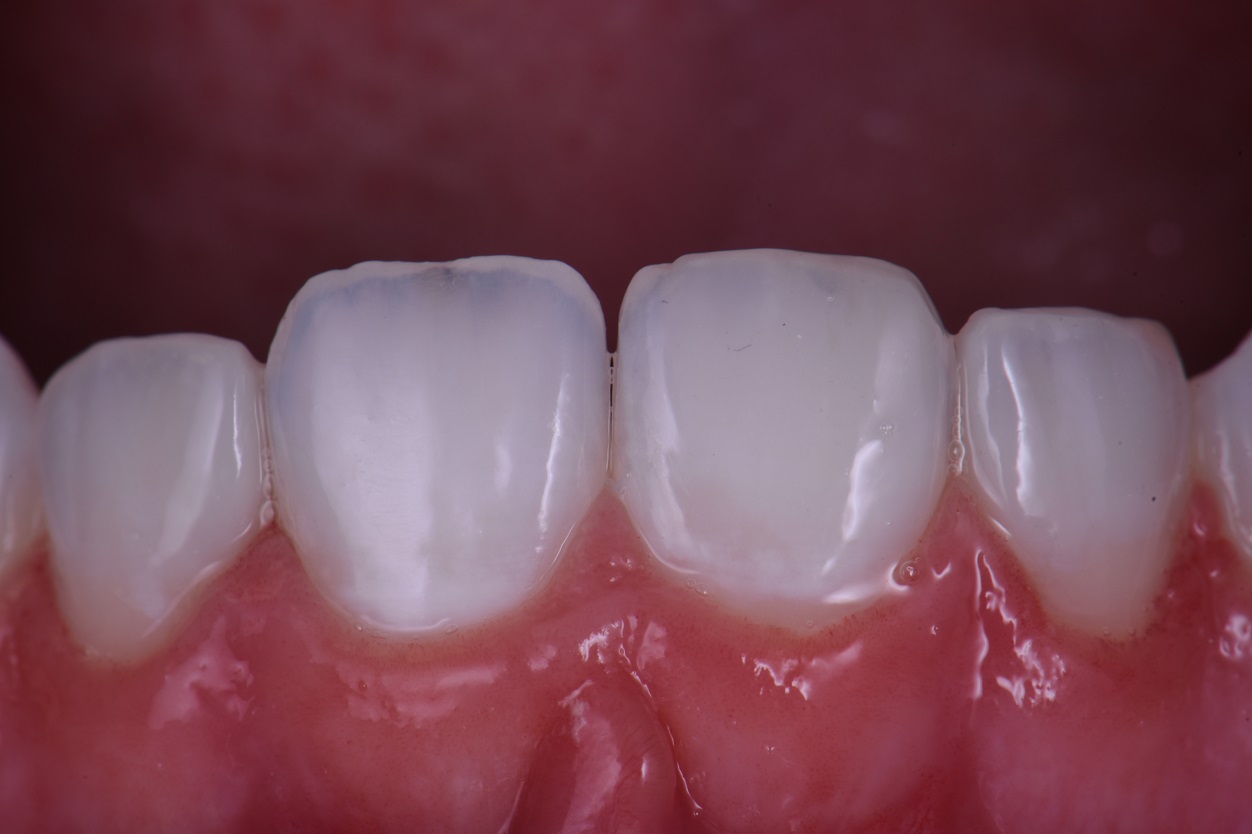 Composite Replacement Restorations Kerr Harmonize Composite Replacement