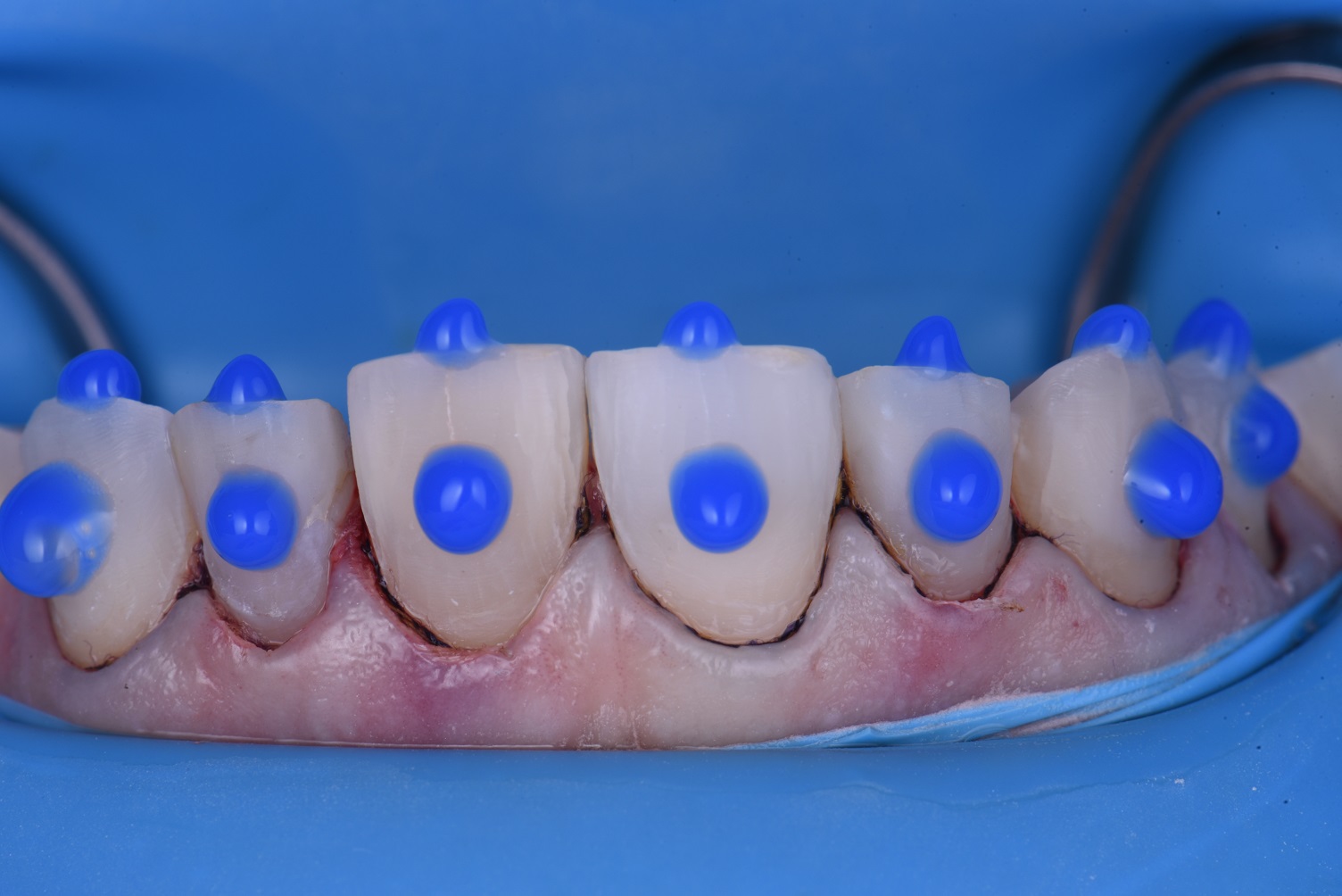 Cosmetic Dental Makeover New Zealand Cosmetic Dental Makeover New Zealand