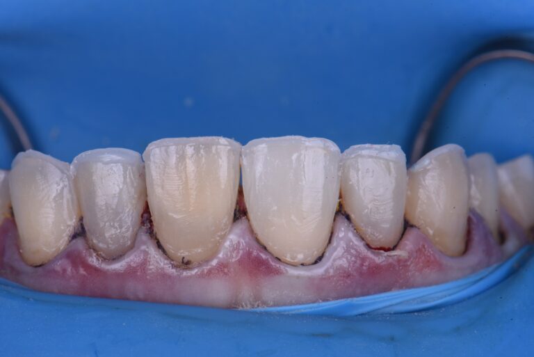 Cosmetic Dental Makeover New Zealand Cosmetic Dental Makeover New Zealand