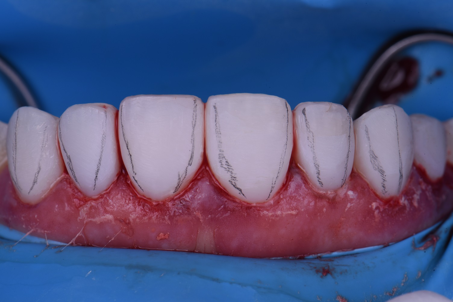 Cosmetic Dental Makeover New Zealand Cosmetic Dental Makeover New Zealand