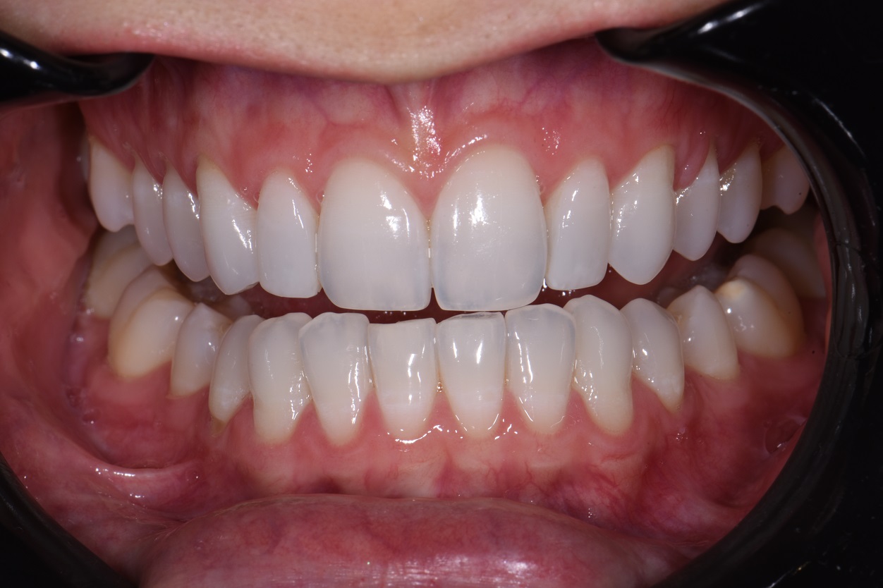 Composite Veneers without drilling